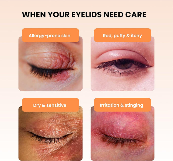 BlephaDerm®